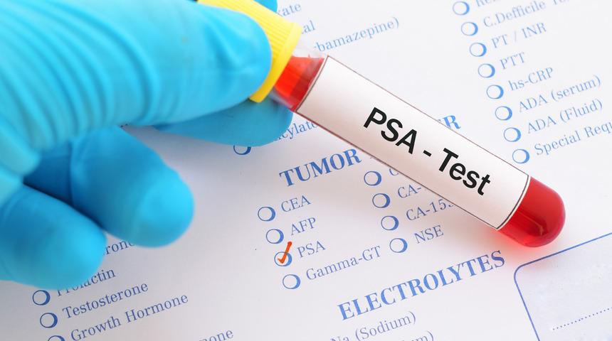 PSA nedir? PSA testi neden yapılır? PSA testi değerleri kaç olmalıdır?