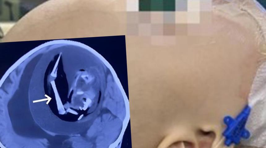Doktorları şaşkına çeviren röntgen görüntüsü! Bebeğin kafatası anormal derecede büyüktü: İçinde cenin olduğunu keşfettiler