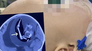 Doktorları şaşkına çeviren röntgen görüntüsü! Bebeğin kafatası anormal derecede büyüktü: İçinde cenin olduğunu keşfettiler