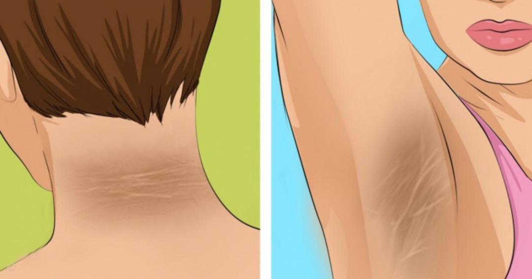 Boynunuzda ve koltuk altınızda lekelenmeler varsa dikkat