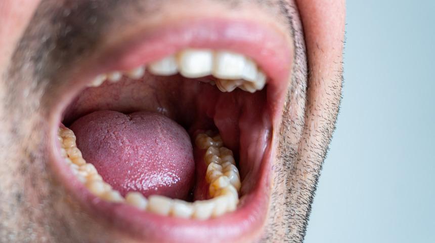 Tükürük bezi taşı nedir, nasıl oluşur? Tükürük bezi taşı tedavisi nasıl yapılır?