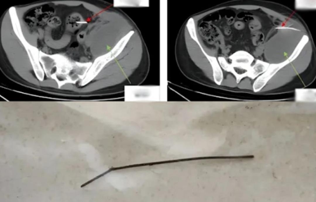 Günlerce tuvaletini yapamadı ve karın ağrısından yürüyemedi! Doktorları şaşırtan röntgen sonucu: Öyle bir şey buldular ki... 1