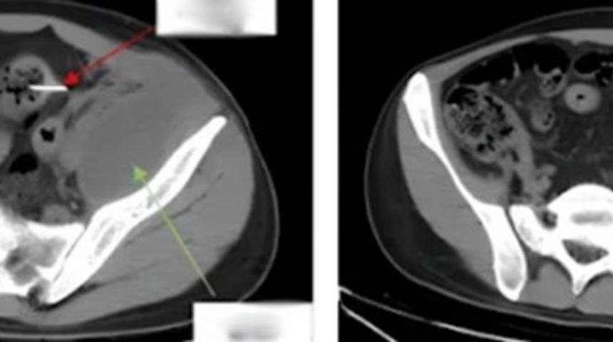 Günlerce tuvaletini yapamadı ve karın ağrısından yürüyemedi! Doktorları şaşırtan röntgen sonucu: Öyle bir şey buldular ki...