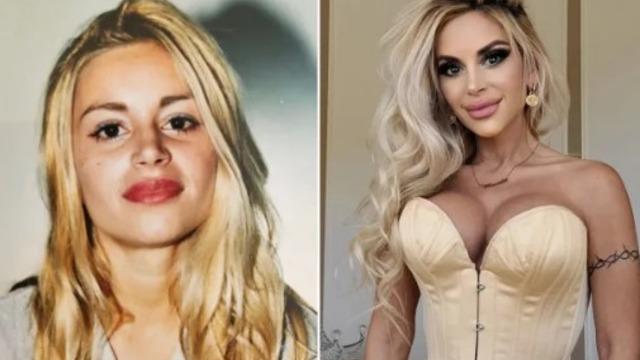 Yüzüne ve vücuduna başkalarının yağını enjekte ettirdi! 9 bin sterlin (400 bin TL) harcadı... Dolgudan daha iyi