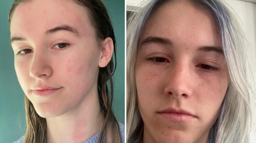 Suya alerjisi olan kadın yağmurlu havada yaşadığı zorlukları anlattı! Su dahil 40 şeye alerjisi var: "Derimi bıçakla kazıyorlar gibi"