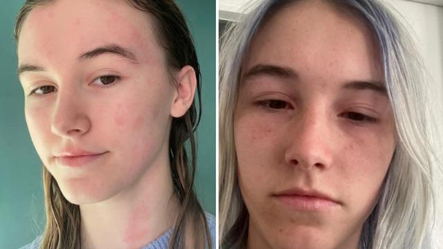 Suya alerjisi olan kadın yağmurlu havada yaşadığı zorlukları anlattı! Su dahil 40 şeye alerjisi var: Derimi bıçakla kazıyorlar gibi