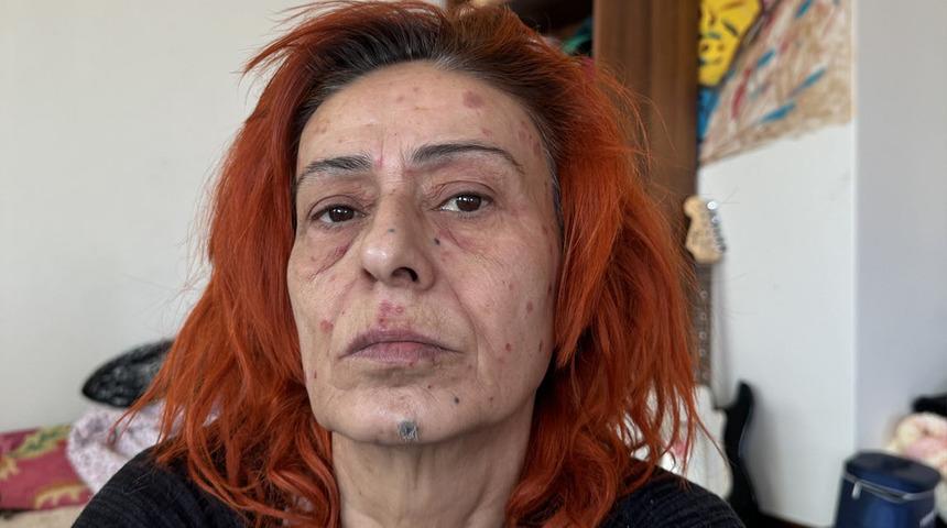 Yıldız Tilbe'nin yüzünde yanıklar oluşmuştu! Uzman isim uyardı: Saç boyamadan önce bunu yapın!