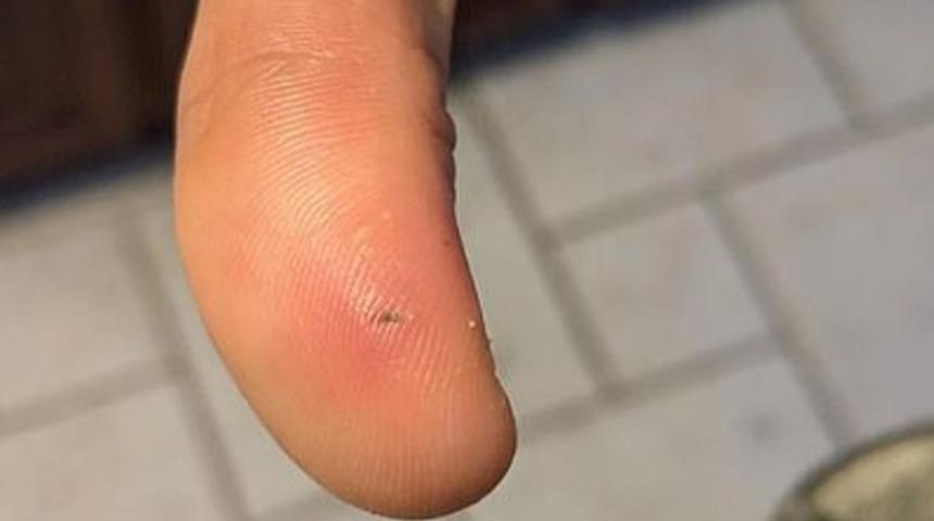 Soğan soyarken kabuğu elini kesince hastanelik oldu! Tehlikeli enfeksiyona yakalanan aşçı zor günler yaşadı: "Tehlike her evin yakınında"