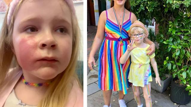 Kızının yanağına bir öpücük kondurdu! Dudağındaki ruj kızının yanağını yaktı:  Benim hatamı yapmayın