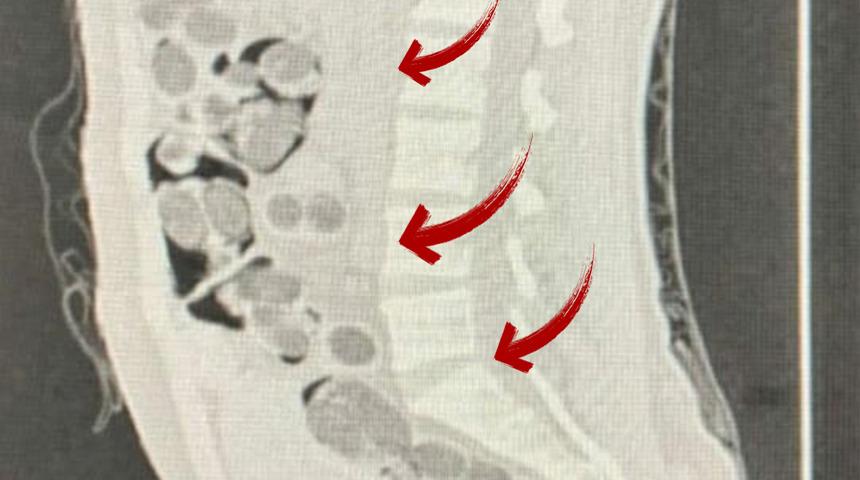Uçakla giriş yapmış! Denizli'de yabancı uyruklu bir kişinin midesinden 219 paket uyuşturucu çıktı