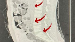 Uçakla giriş yapmış! Denizli'de yabancı uyruklu bir kişinin midesinden 219 paket uyuşturucu çıktı