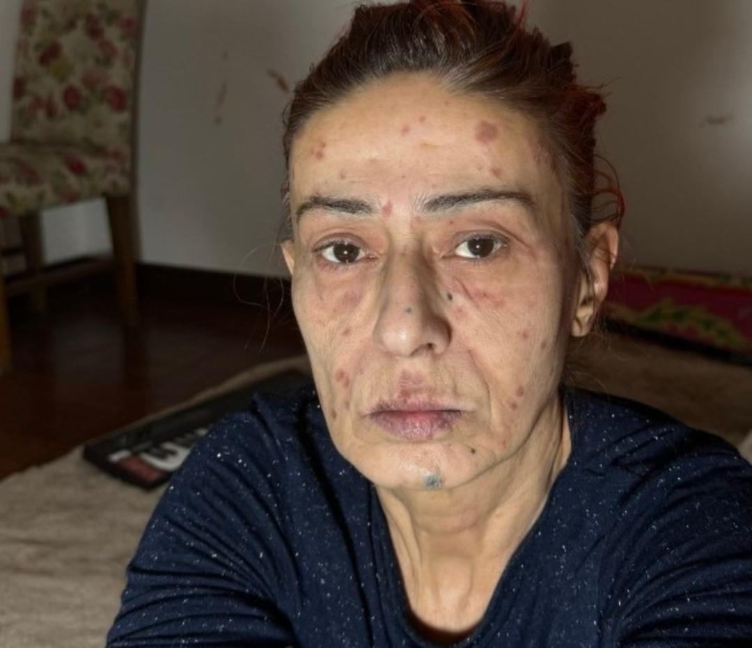 Saç boyası yüzünden yüzü yanmıştı! Yıldız Tilbe son halini gösterdi 2