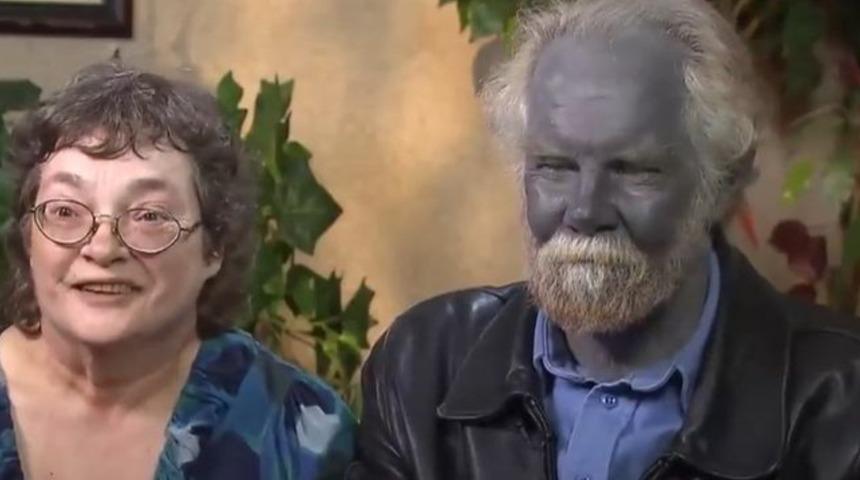 Aman dikkat! Bu hastalığa yakalanırsanız 'kalıcı' olarak renginiz değişiyor: Nedeni şaşkına çeviriyor...