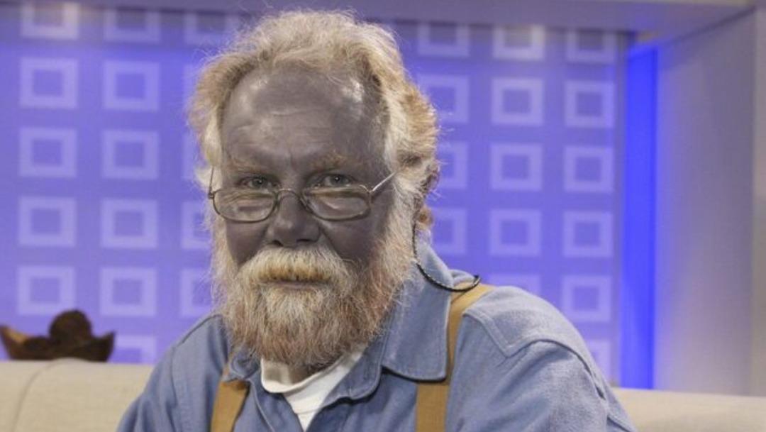 Aman dikkat! Bu hastalığa yakalanırsanız kalıcı olarak renginiz değişiyor: Nedeni şaşkına çeviriyor... 1