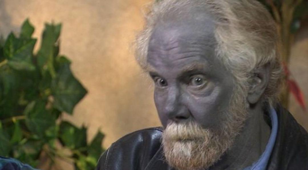 Aman dikkat! Bu hastalığa yakalanırsanız kalıcı olarak renginiz değişiyor: Nedeni şaşkına çeviriyor... 2