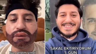 Saç ekiminden sonra sırada sakal ekimi var! Operasyondan çıktıktan sonraki halini paylaşınca viral oldu: Ağlayamıyorum o kadar şiştim