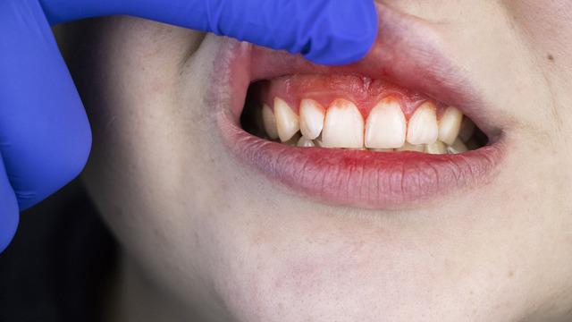 Ağızda başlayıp kan yoluyla kalbe iniyor: Önlem alınmazsa kalp krizi riskini artırıyor! 8 belirtiye dikkat