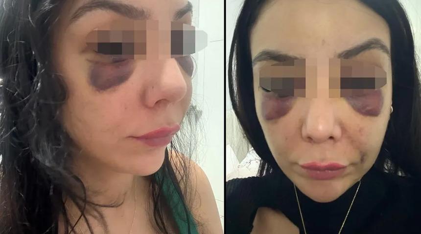 Konya'da korkunç olay! Eğlence merkezinin tuvaletinde defalarca yumrukladı... Baygınlık geçiren kadının yüzü tanınamaz hale geldi