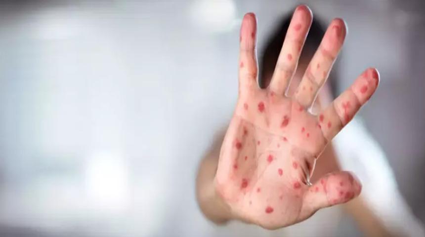 ABD'de yeni salgın alarmı! Vaka sayısı 48'e yükseldi... 30 yıldan uzun süredir görülen en büyük!