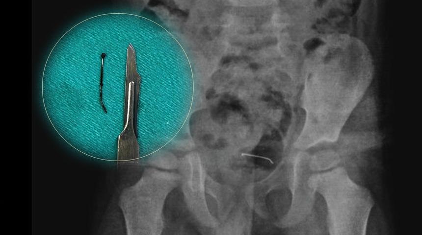 Tam 9 ay  önce yutmuş... 5 yaşındaki çocuğun mesane duvarına yapışmış! 