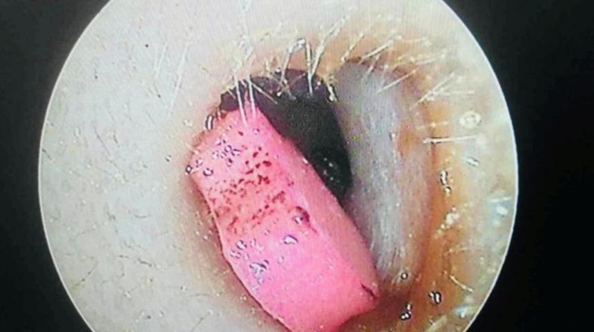 5 yaşındaki çocuğun ateşi bir anda yükseldi! Kulağından çıkan doktorları bile şaşkına çevirdi: Evdeki her çocuğun başına gelebilir