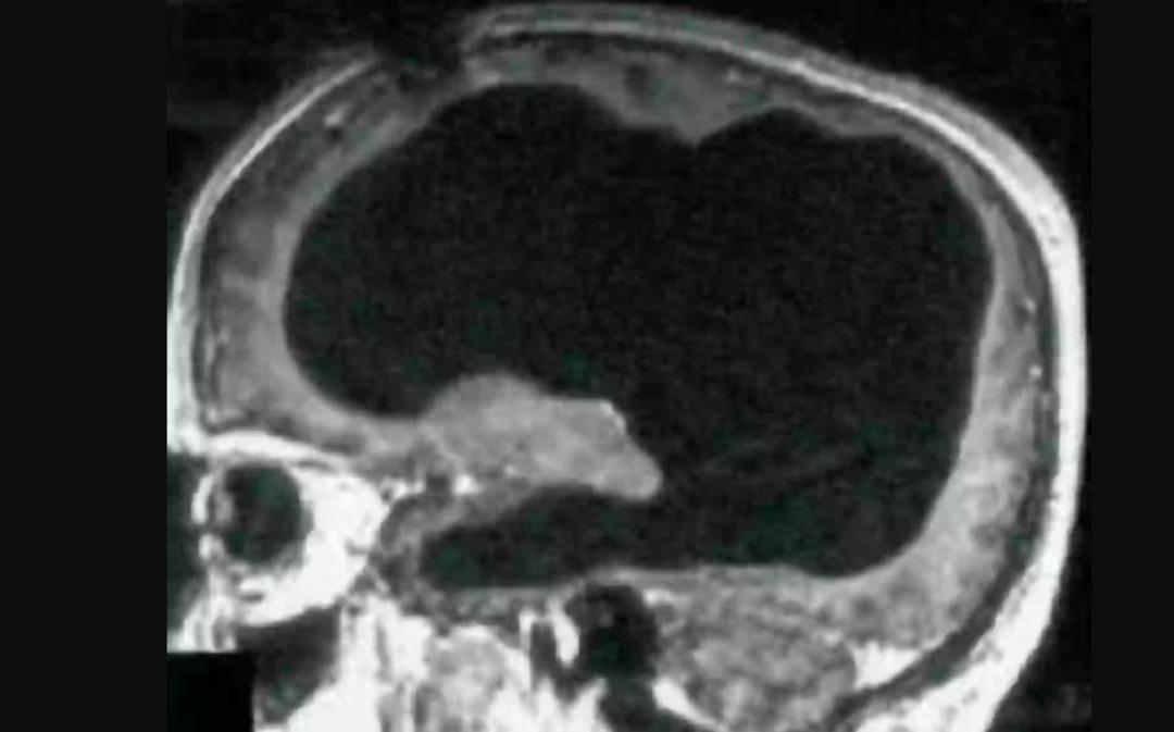 Yaygın bir semptomdan muzdarip olan adam,  yarım beyinle  yaşadığını keşfetti! "Herkes hissedebilir" 1