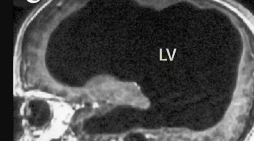 Yaygın bir semptomdan muzdarip olan adam, 'yarım beyinle' yaşadığını keşfetti! "Herkes hissedebilir"