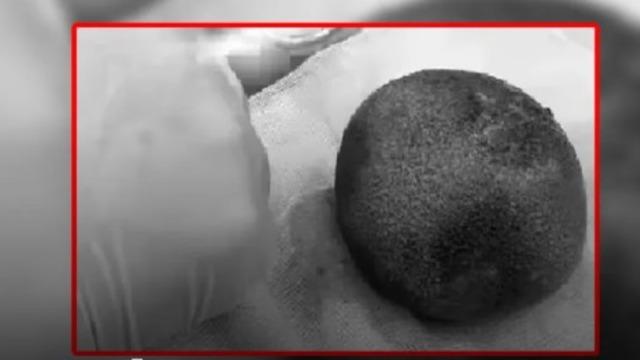 Mide ağrısı şikayetiyle hastaneye gitti! Mesanesinden 300 gram ağırlığında taş çıkartıldı: Ne yiyip ne içtiğinize dikkat edin