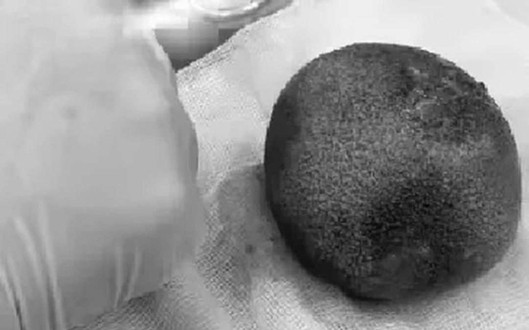 Mide ağrısı şikayetiyle hastaneye gitti! Mesanesinden 300 gram ağırlığında taş çıkartıldı: "Ne yiyip ne içtiğinize dikkat edin" 1