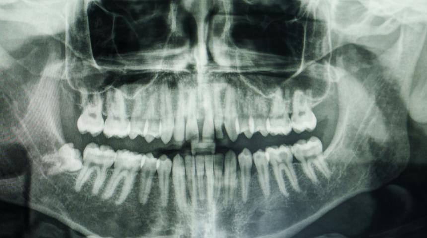 Kemik grefti nedir, nasıl yapılır? Kemik grefti çeşitleri nelerdir?