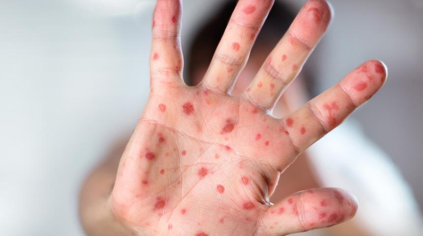 Özellikle çocuğu olanlar dikkat… Kızamık tehlikesi geri döndü: Aşı olmayan çocuk hayatını kaybetti! 