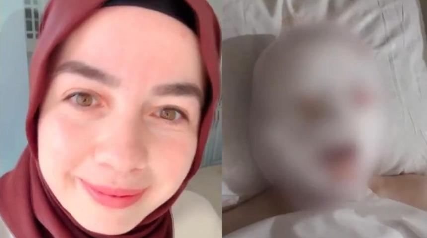 Avcılar'da ikinci Bergen vakası: Yüzüne kezzap atıp gözlerini kör etti! Talihsiz kadın yürek sızlattı: "Ağlıyorum gözlerimden kan geliyor"