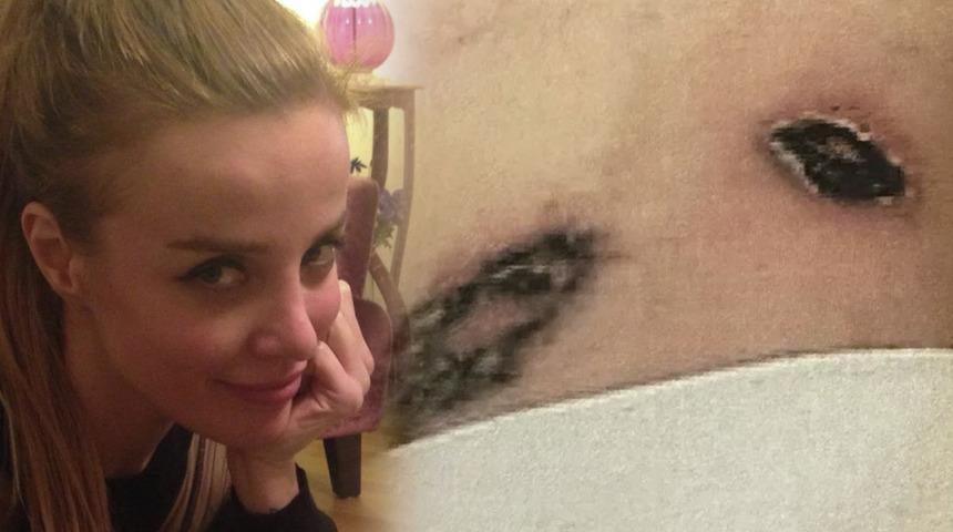 Dövmelerini sildirmek isteyen yazar kabusu yaşadı! Kolunu kaybetme riski olduğunu öğrenince harekete geçti