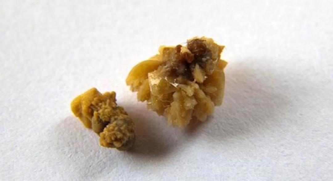 Evde b&ouml;brek taşı nasıl d&uuml;ş&uuml;r&uuml;l&uuml;r?