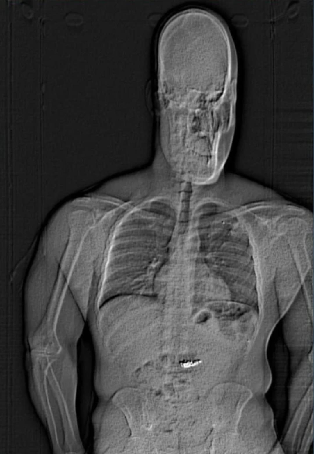 Polisin gözü önünde servet yuttu! 770 bin dolarlık küpeler röntgenle görüntülendi... 3