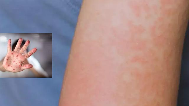  ABD’de kızamık alarmı! Ölüm oranları artıyor…