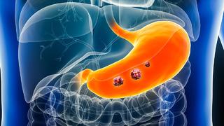 Mide kanserinde yeni tedavi yöntemleri yaşam süresini uzatıyor