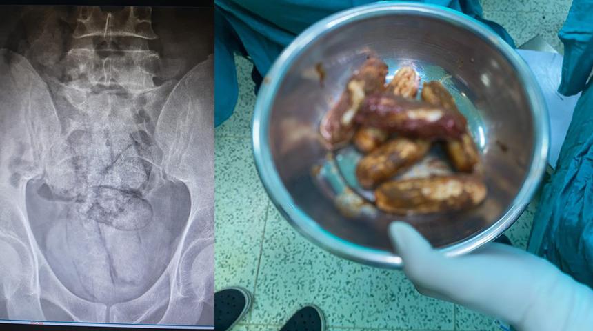 Hepsini bağırsağında saklamış! Artvin'de İranlı şüpheli gözaltına alındı