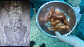 Hepsini bağırsağında saklamış! Artvin'de İranlı şüpheli gözaltına alındı