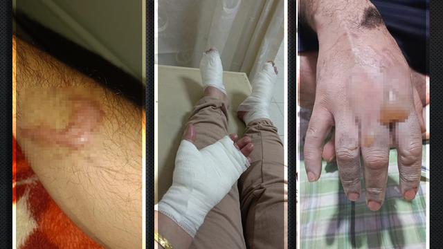 Hakkari'de lavabo açıcı patladı: İki kardeşin vücudu yandı! Üzerindeki kıyafetler tamamen eridi