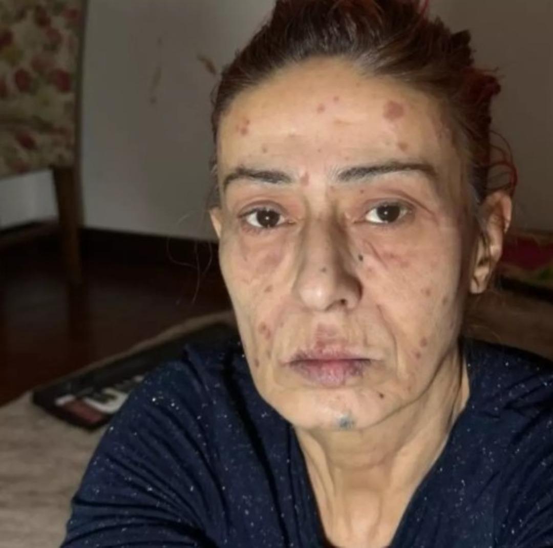 Saç boyası yüzünü yakmıştı! Yıldız Tilbe son durumunu açıkladı 2