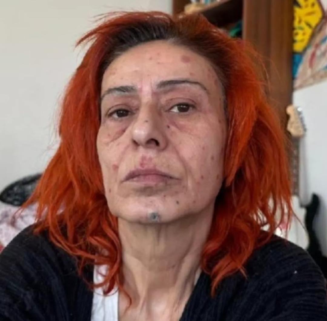 Saç boyası yüzünü yakmıştı! Yıldız Tilbe son durumunu açıkladı 1