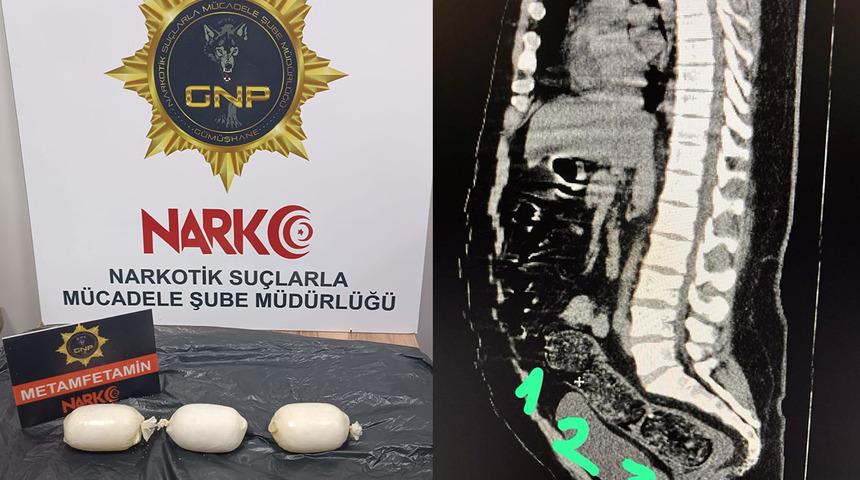 Uyuşturucu dolu kapsüller bağırsaklarından çıktı