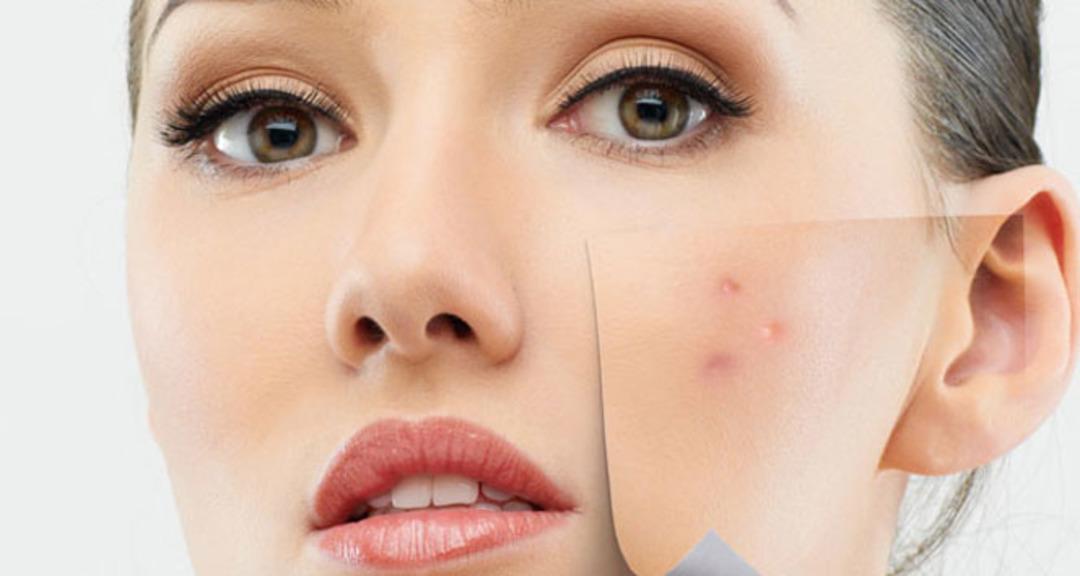 Güneş lekeleri ve ciltteki kahverengi lekeler: Neden olur, nasıl önlenir ve tedavi edilir? 5