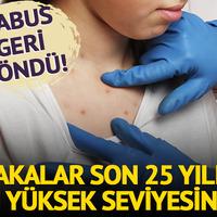 Kızamık geri döndü: Vaklar son 25 yılın en yüksek seviyesinde!