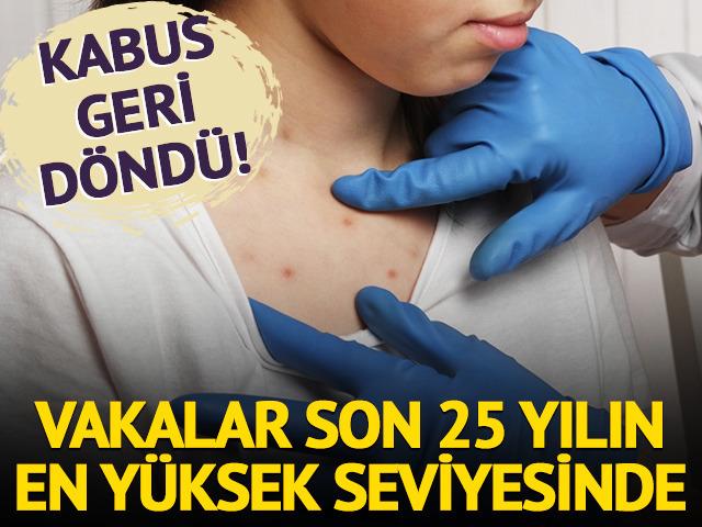 Kızamık geri döndü: Vaklar son 25 yılın en yüksek seviyesinde!