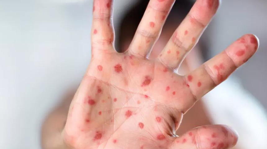 Kızamıkta, 27 yıl sonra en yüksek vaka sayısı! Avrupa için alarm... DSÖ: "Geri döndü"