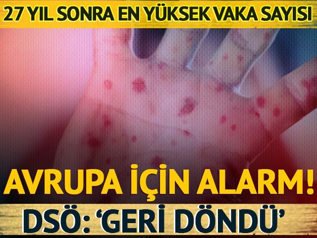 Kızamıkta, 27 yıl sonra en yüksek sayı! Avrupa'da alarm