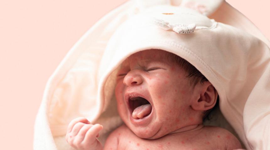 Dünyada kızamık salgını alarmı! Hastanede alarm verildi: Yenidoğan bebekler tehlikede