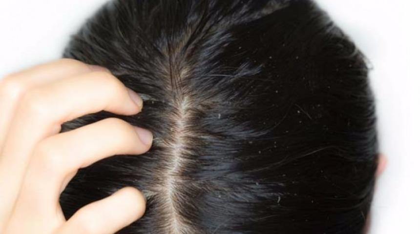 Saç kaşıntısına ne iyi gelir? Saç kaşıntısına iyi gelen bitkisel çözümler, doğal şampuanlar